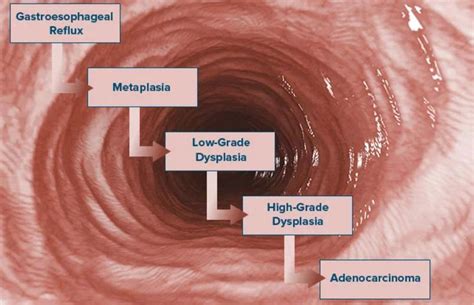 esophageal cancer life expectancy